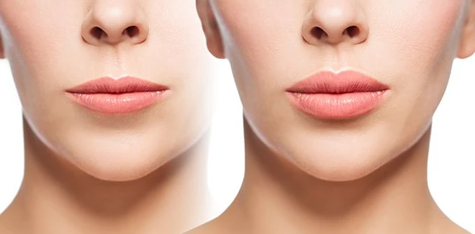 Lip Filler Before and After: A Comprehensive Guide